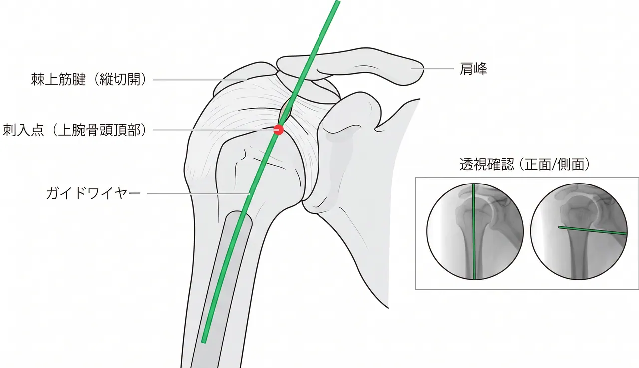 エントリーポイント — 上腕骨頭頂部（肩峰後内側）のガイドワイヤー刺入と透視確認