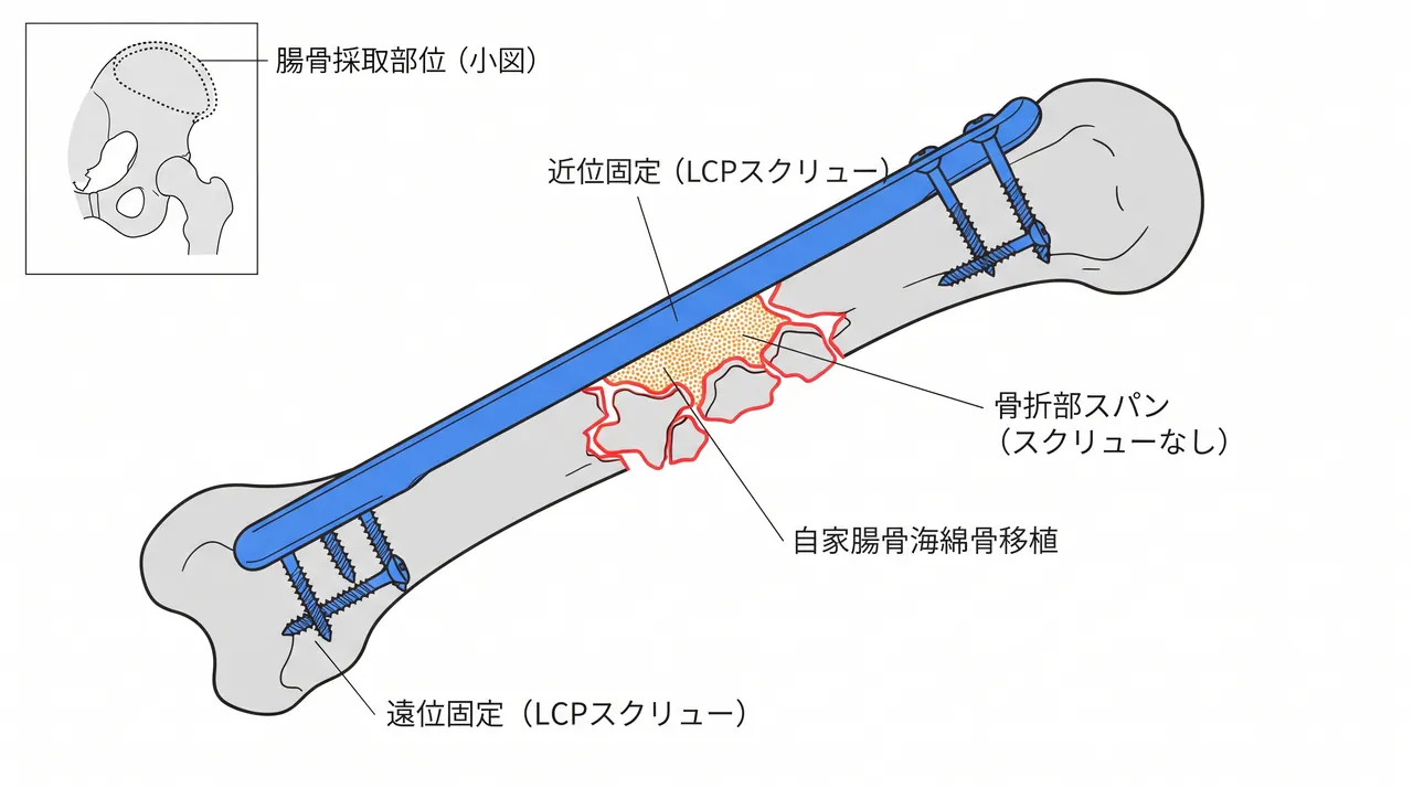 ブリッジプレート設置概念図 — 長LCPプレートによる全骨折部の橋渡し固定と骨移植充填