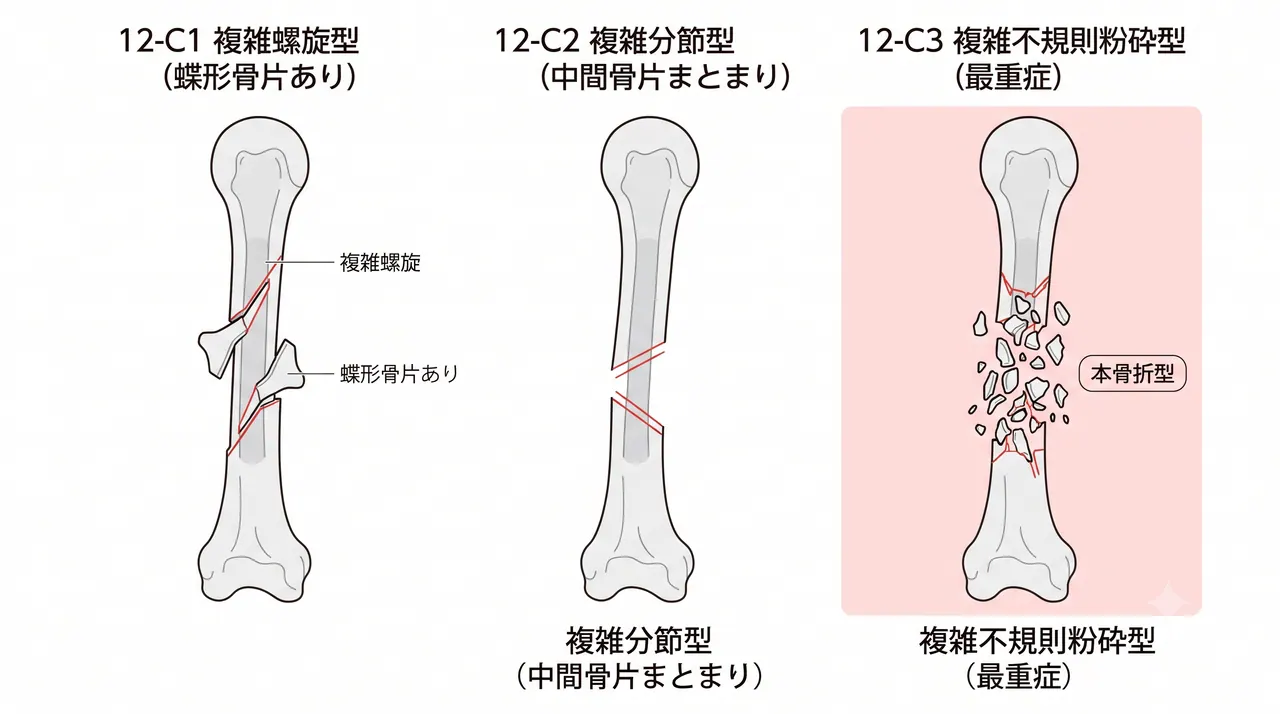 AO分類 12-C3 骨折型模式図 — 複雑不規則粉砕型（骨片多数・分節構造不明瞭な最重症型）