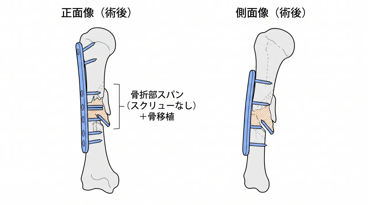 術後X線像（正面/側面）— ブリッジプレート固定（長LCPで全骨折部をカバー・骨移植充填後）