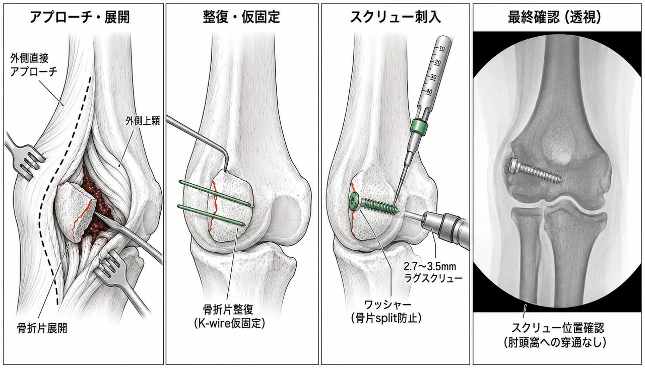 外側上顆ORIF — 直接外側アプローチ、骨折片整復・2.7mm〜3.5mmラグスクリュー固定手順