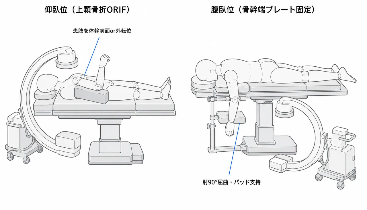 体位・Cアームセットアップ（仰臥位/腹臥位）