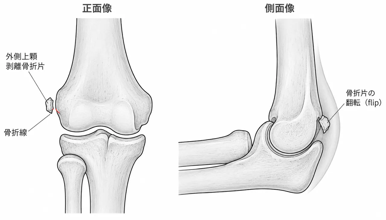 術前X線正面像（外側上顆剥離骨折 — 骨折片・転位量）＋側面像（骨折片の立ち上がり確認）