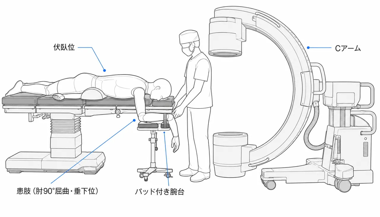 手術体位（13-A2 上腕骨遠位部 — 伏臥位または側臥位）