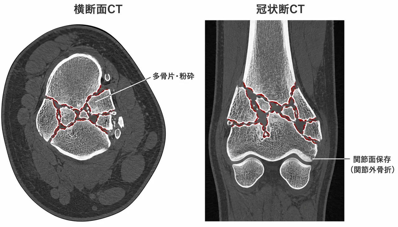 CT所見（横断面/冠状断面）— 13-A3 骨片数・粉砕範囲・関節外確認
