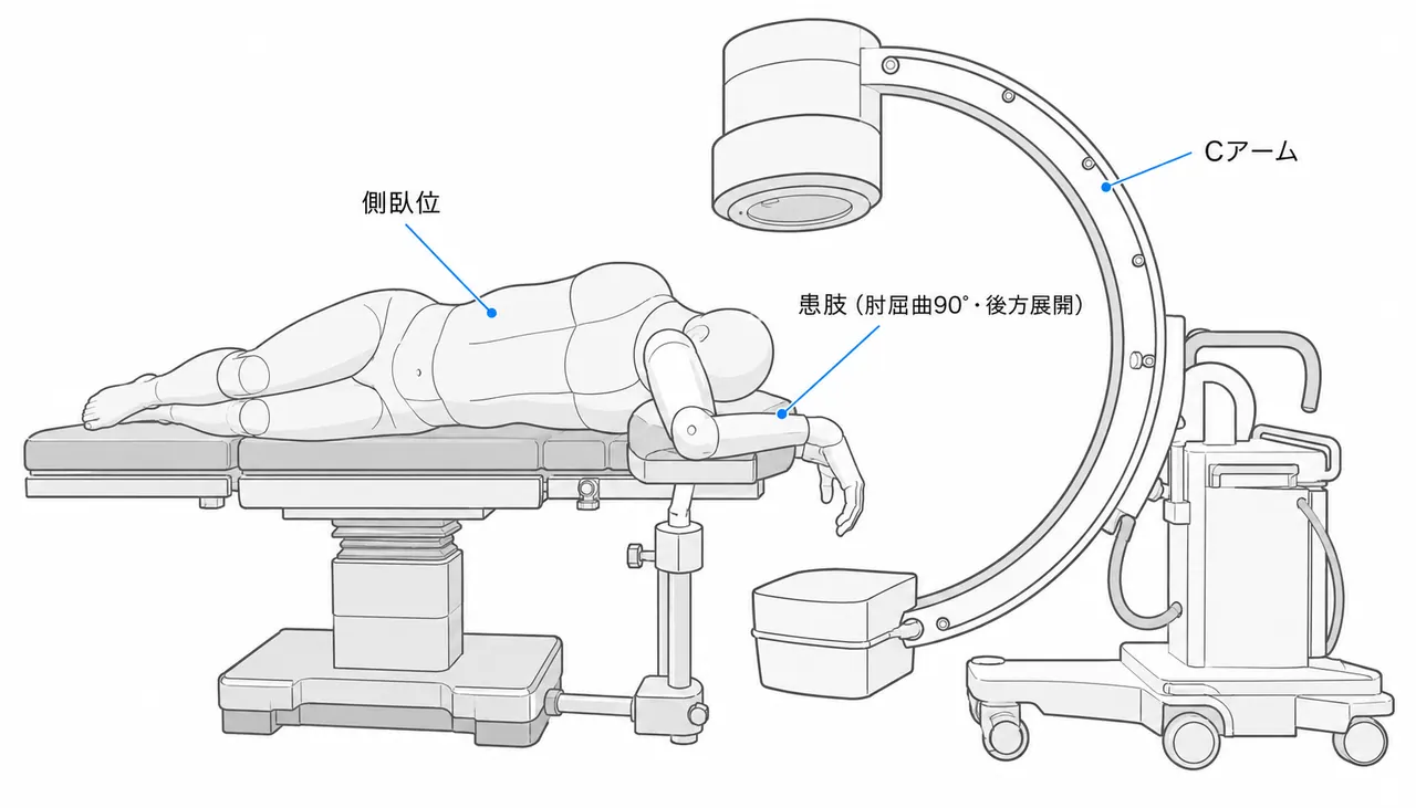 手術体位 — 側臥位または腹臥位（後方アプローチ・肘関節屈曲90°、Cアームセットアップ）