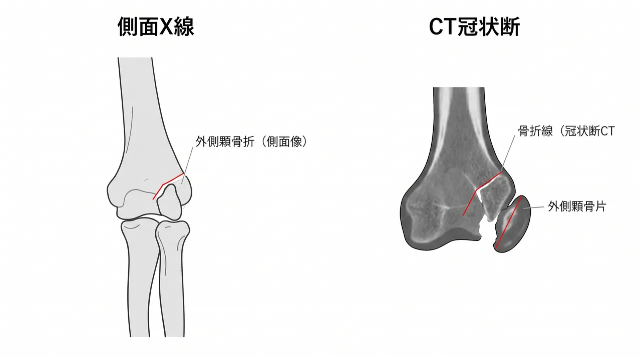 術前X線（側面像）＋CT冠状断 — 骨折線の走行・Milch分類・関節面転位量の評価