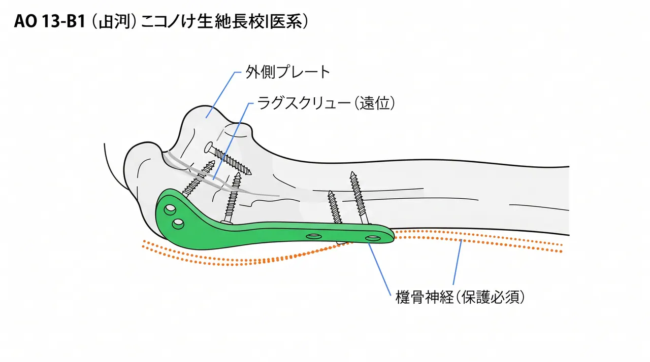 ラグスクリュー + 外側プレート固定 — 骨幹端延長型外側顆骨折への外側プレート適用（橈骨神経保護）
