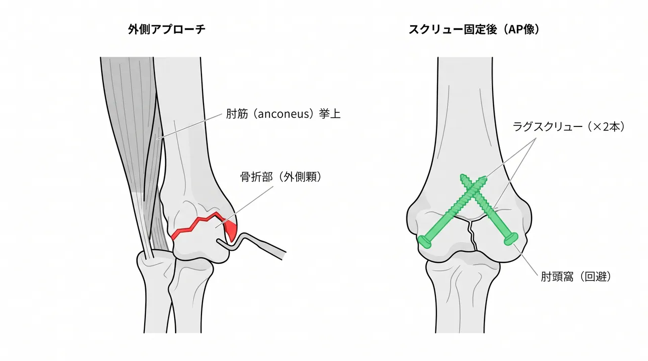 外側直接アプローチ — 上腕三頭筋・肘筋の外側柱からの展開と外側顆骨片の直視下整復