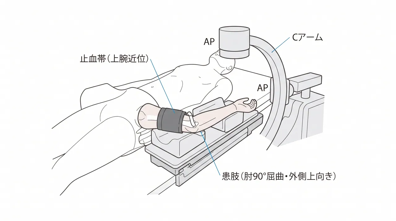 手術体位（仰臥位）— 患側上肢の展開・止血帯位置・外側アプローチのドレーピング
