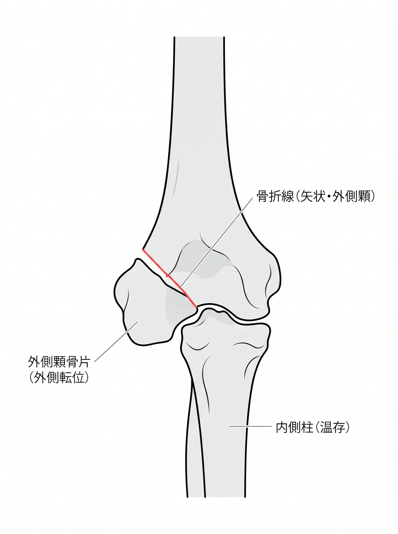 術前X線（AP像）— 外側顆骨折線（斜め走行）と外側顆骨片の外側転位