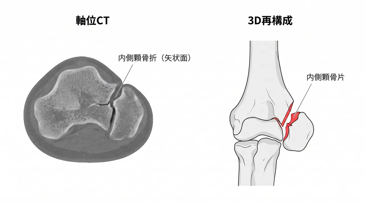 CT横断面 + 3D再構成（骨折形態・粉砕評価・手術計画）