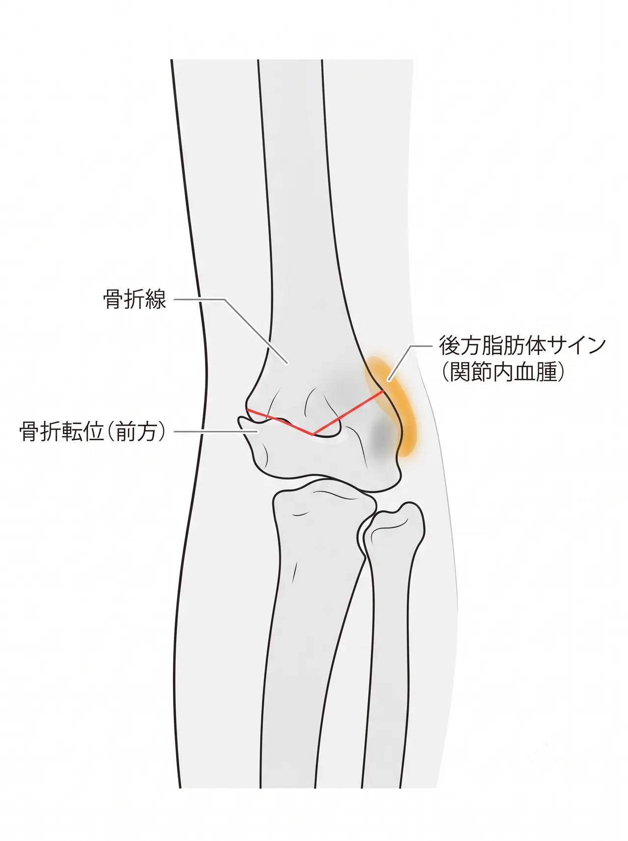 X線側面像 — 骨折転位方向・関節内血腫（hemarthrosis）所見