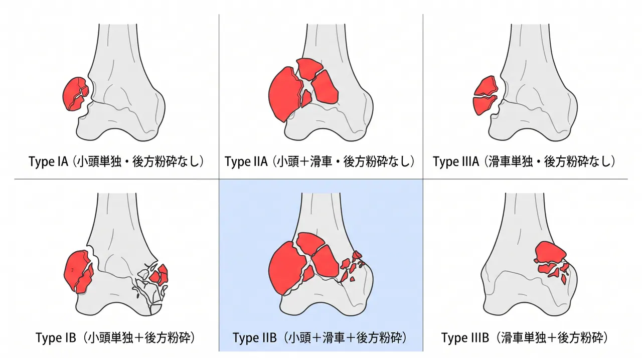 Dubberley分類図 — Type I（小頭単独）/ Type II（小頭＋滑車、一体型）/ Type III（小頭＋滑車が分離・複数骨片型）× A（後方皮質粉砕なし）/ B（後方皮質粉砕あり）