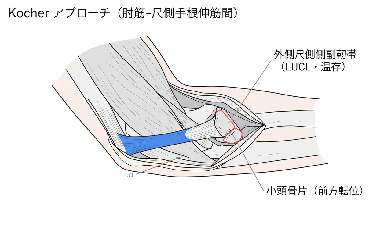 Kocher アプローチ — 外側尺側側副靱帯（LUCL）を温存した関節展開と小頭骨片の直視
