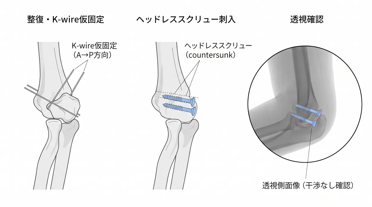 ORIF 手技 — ヘッドレス圧迫スクリューを前方→後方（A→P）方向に2本刺入（countersunk）、透視側面像での確認