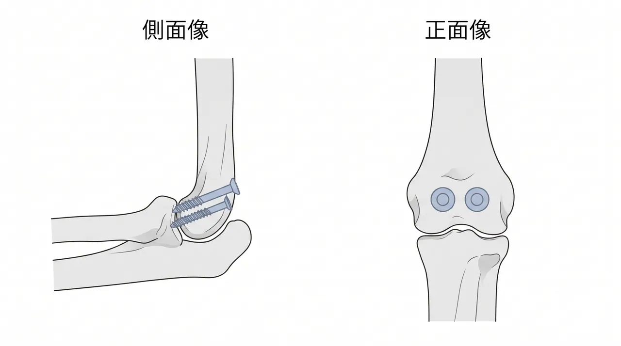 術後X線像（側面）— 上腕骨小頭にA→P方向ヘッドレス圧迫スクリュー2本（countersunk）、骨片整復位