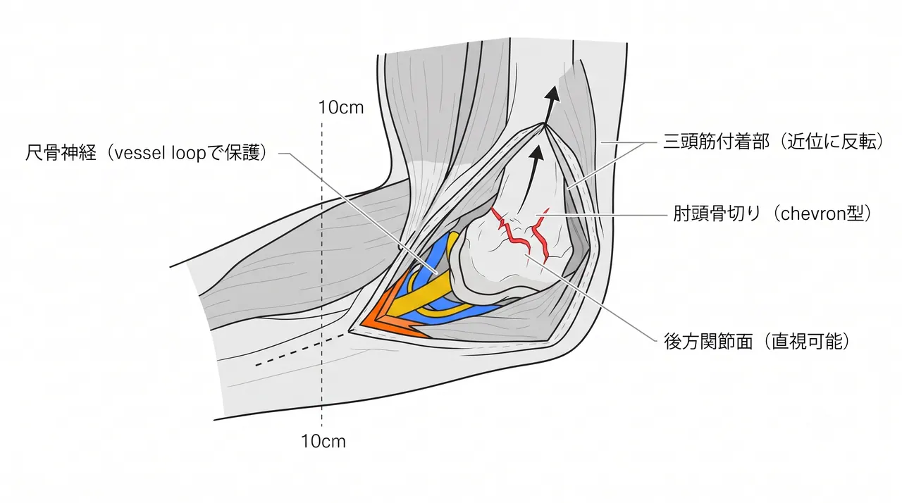 後方アプローチ（肘頭骨切り術）— 後方正中切開、肘頭の山型骨切り（chevron）、三頭筋付着部を温存したまま遠位に反転