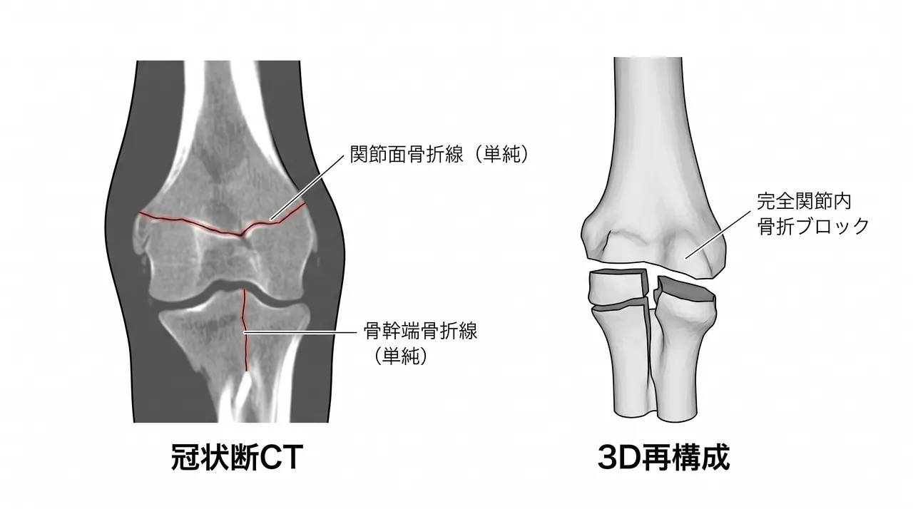 CT冠状断・3D再構成 — 関節面骨折線と骨幹端骨折の形態確認（13-C1：単純関節・単純骨幹端）