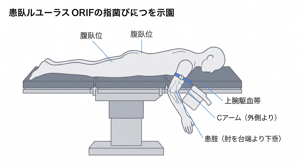 手術体位（腹臥位・後方アプローチ）— 患肢を台端より下垂、Cアームを対側から挿入