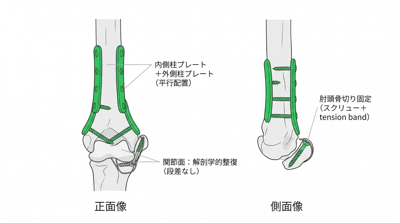 術後X線（AP・側面）— 二重プレート固定後。関節面は解剖学的整復、内外側柱にプレート配置、肘頭骨切り部は固定済み