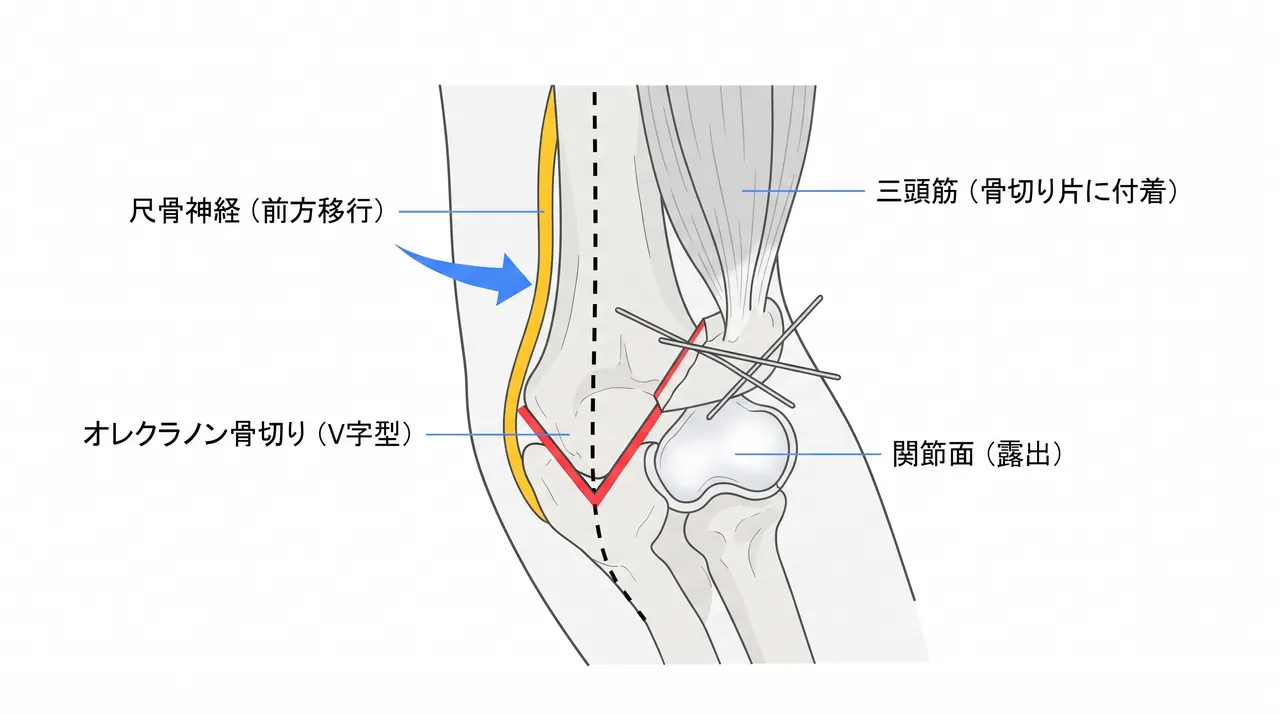 後方オレクラノン骨切りアプローチ — 尺骨オレクラノンを骨切りして翻転し、上腕骨遠位部関節面を直視下に展開