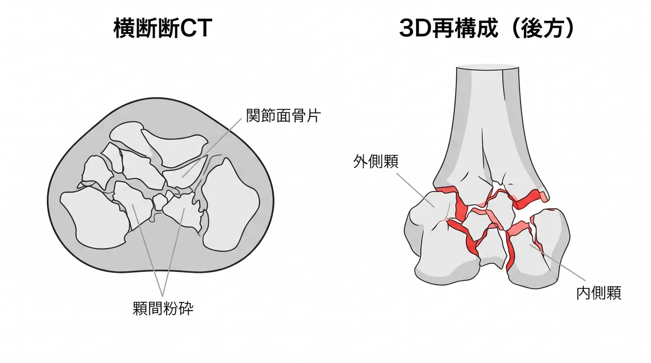 CT 3D再構成（後方観察）— 関節面骨片・内外側顆の粉砕パターンを立体的に把握