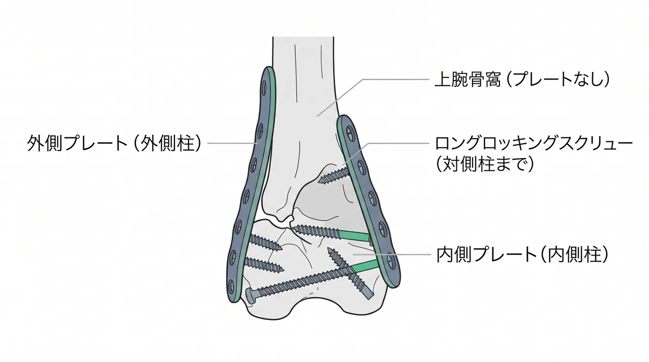 ORIF ダブルプレート — 外側・内側に解剖学的プリコントアドプレートを垂直または平行に配置し、長いロッキングスクリューで関節ブロックを固定