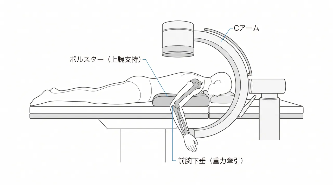 手術体位（腹臥位）— 上腕をボルスターに乗せ前腕下垂、Cアームは上腕骨遠位部を撮影できる位置に設置