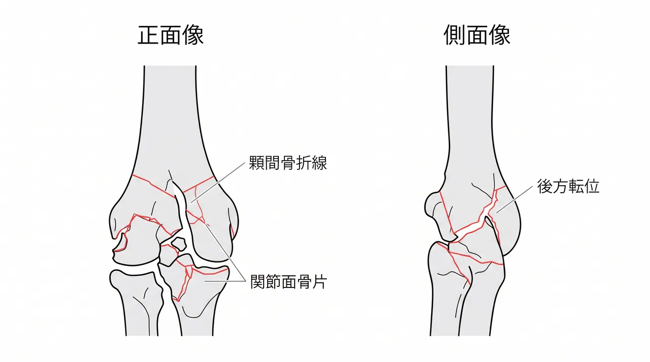 術前X線（AP像・側面像）— 上腕骨遠位部の多骨片関節内骨折。顆間粉砕・転位を確認