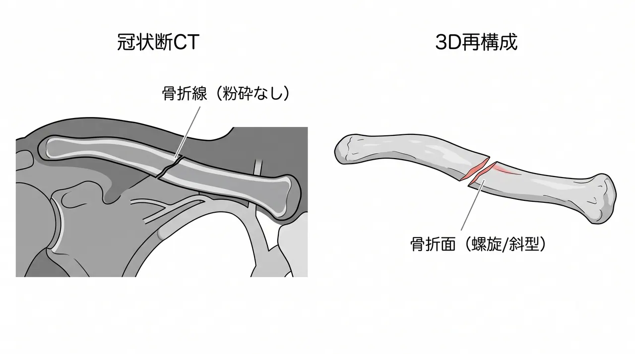 CT冠状断および3D再構成 — 骨折形態・転位方向の詳細評価
