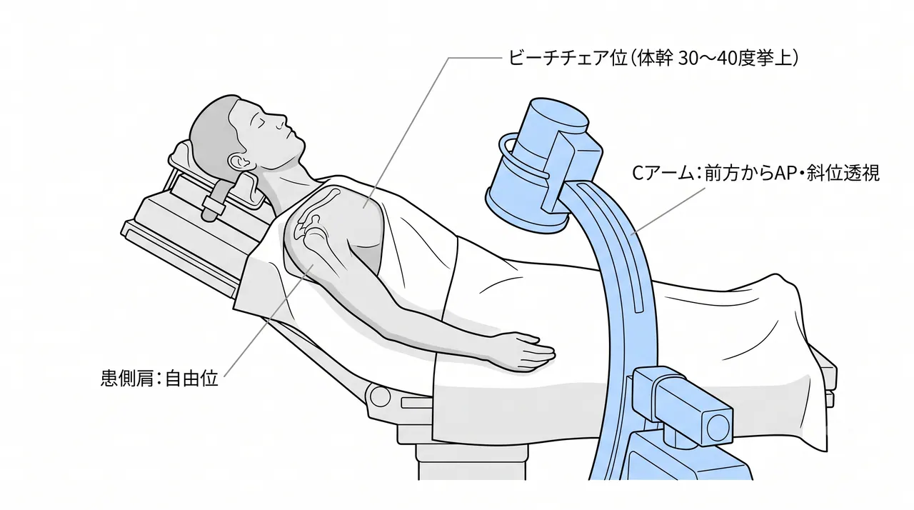 手術体位・ビーチチェアポジション