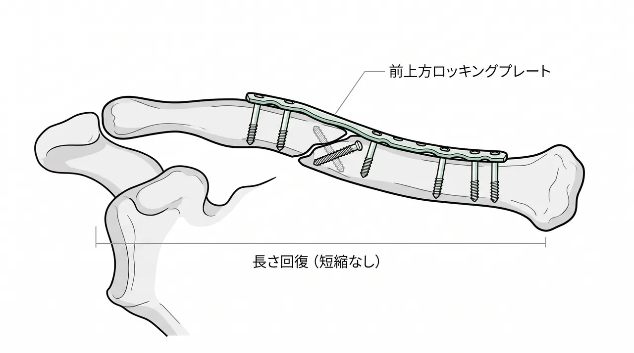 術後X線像（正面）— プレート位置・鎖骨長さ・整復位の確認
