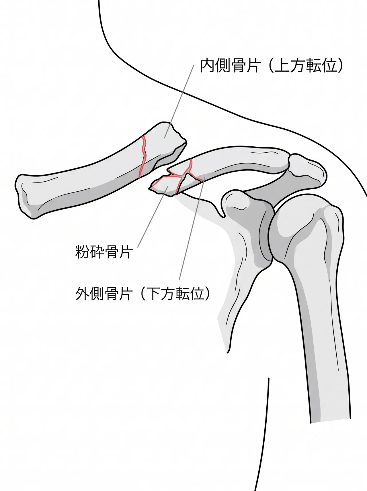 X線正面像 — 骨折形態・短縮・骨片数の確認