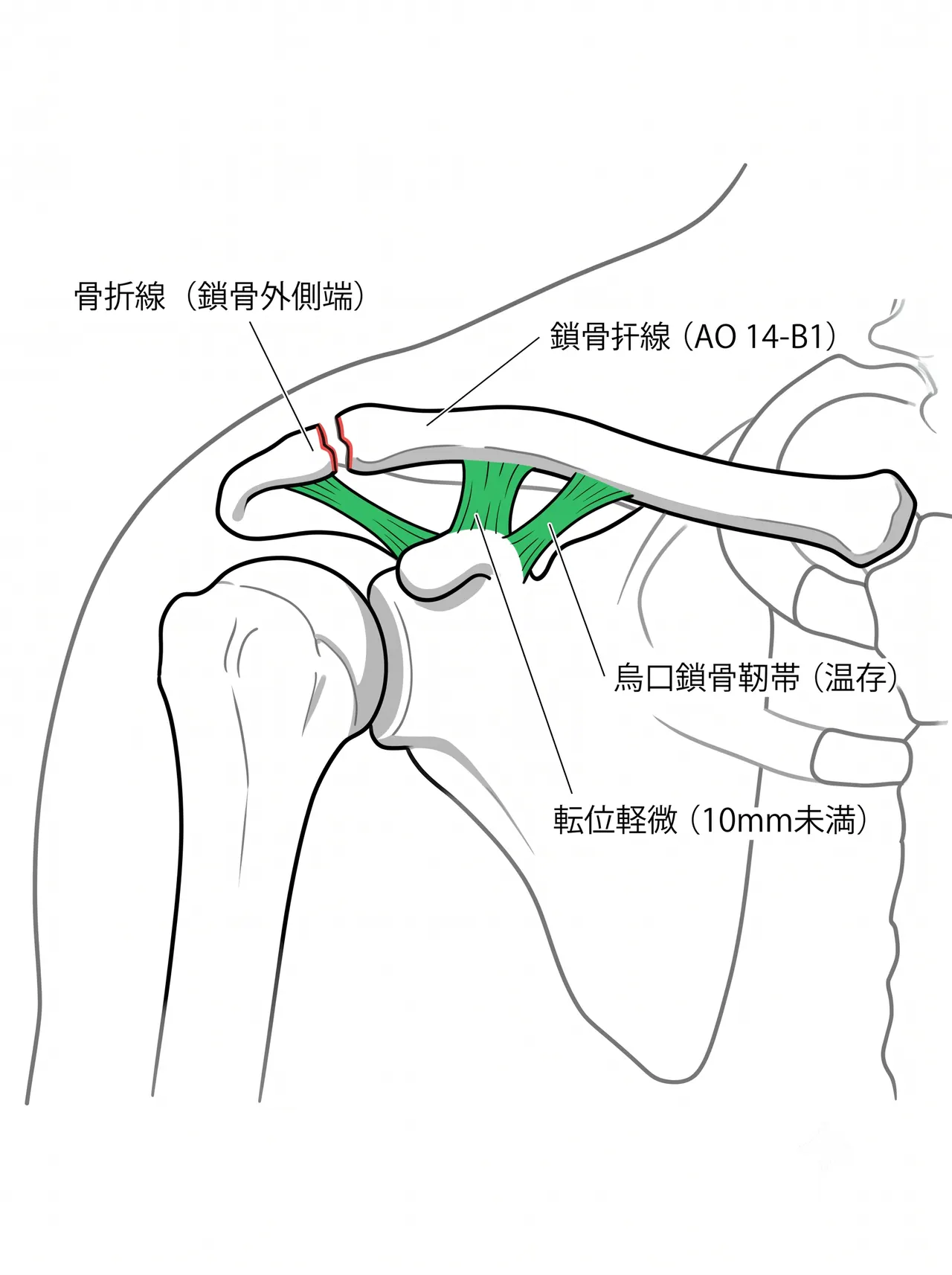 CT像 — 骨折線・骨片位置の確認