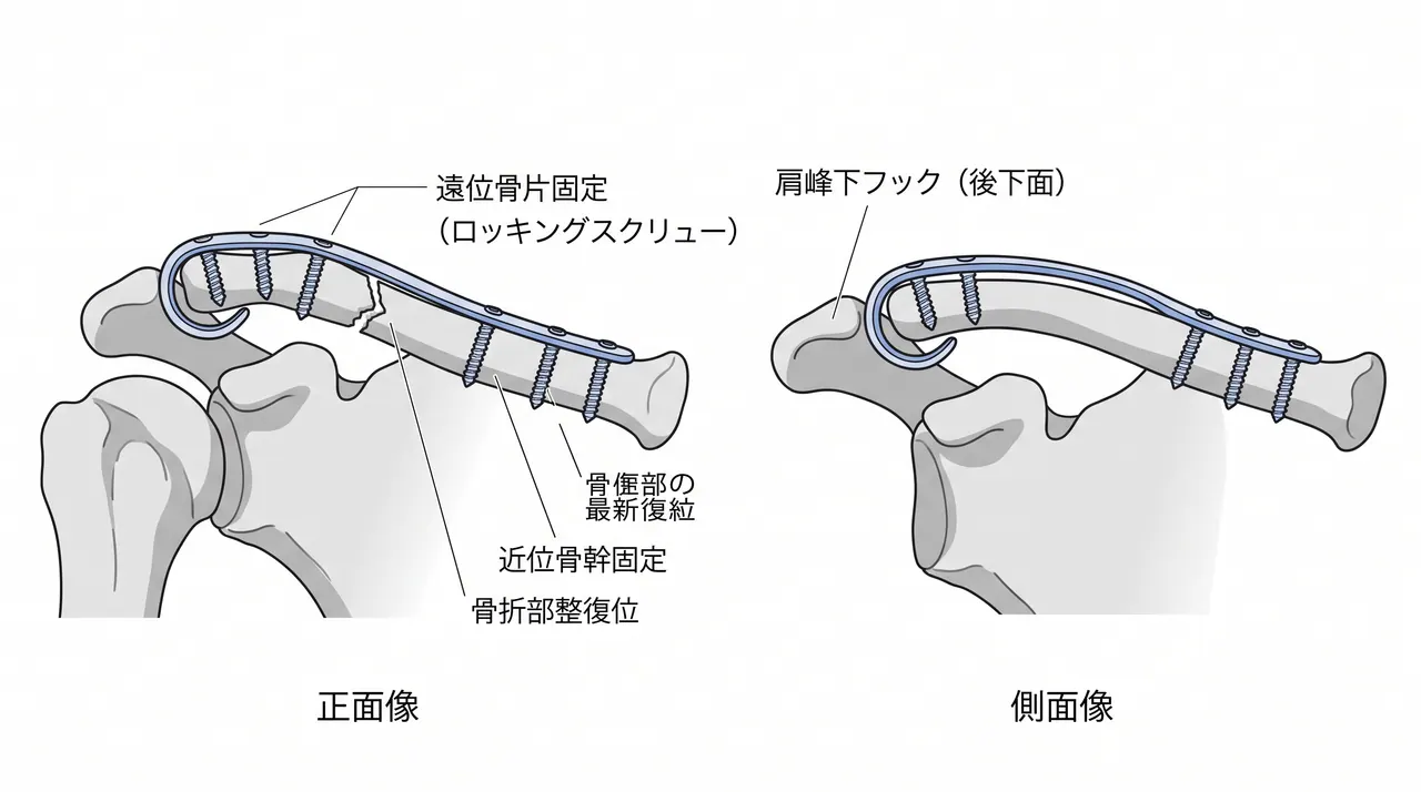 鈎プレート設置概念図 — 肩峰下フック＋鎖骨プレート固定