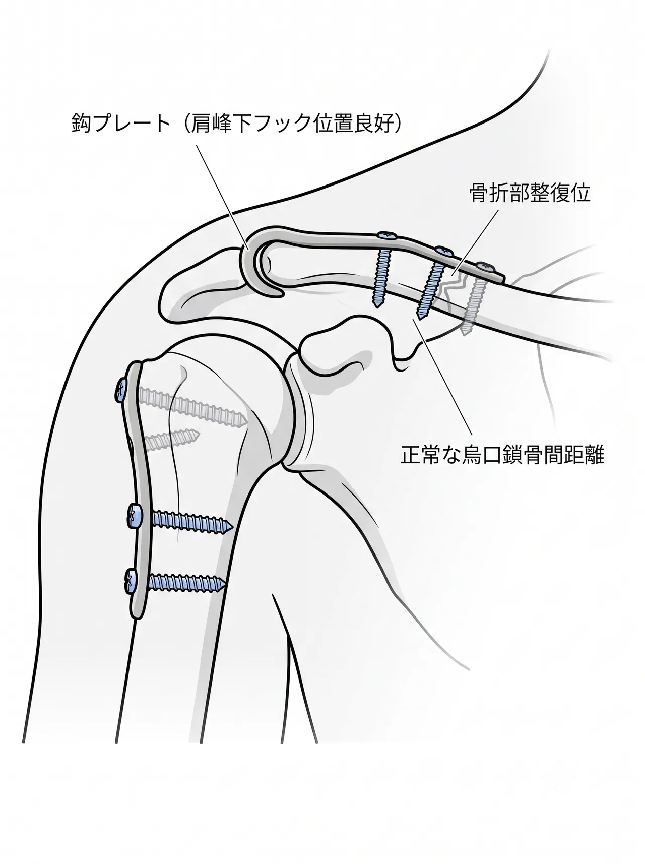 術後X線像（正面像）— 整復位・プレート位置確認