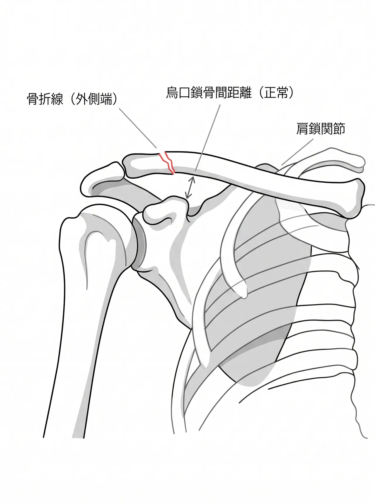 X線正面像（Zanca view）— 骨折型・烏口鎖骨間距離の評価