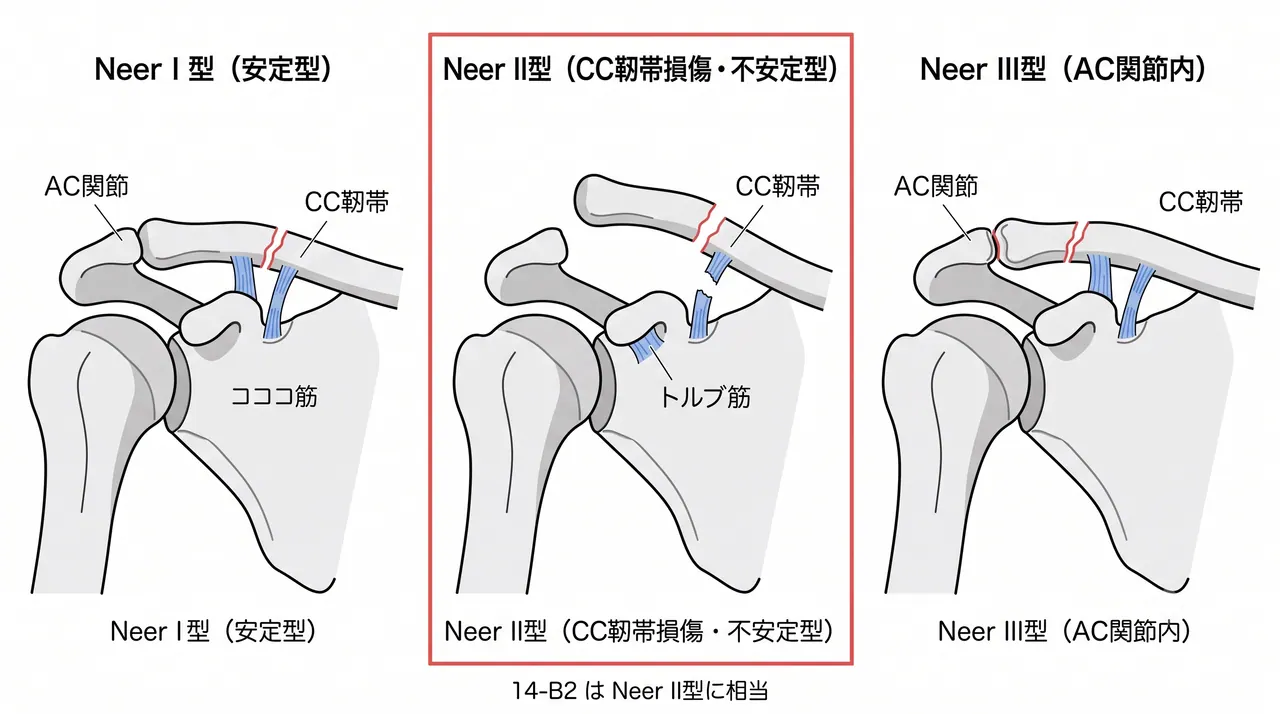 Neer分類 — 外側鎖骨骨折のタイプ分類（I/II/III）