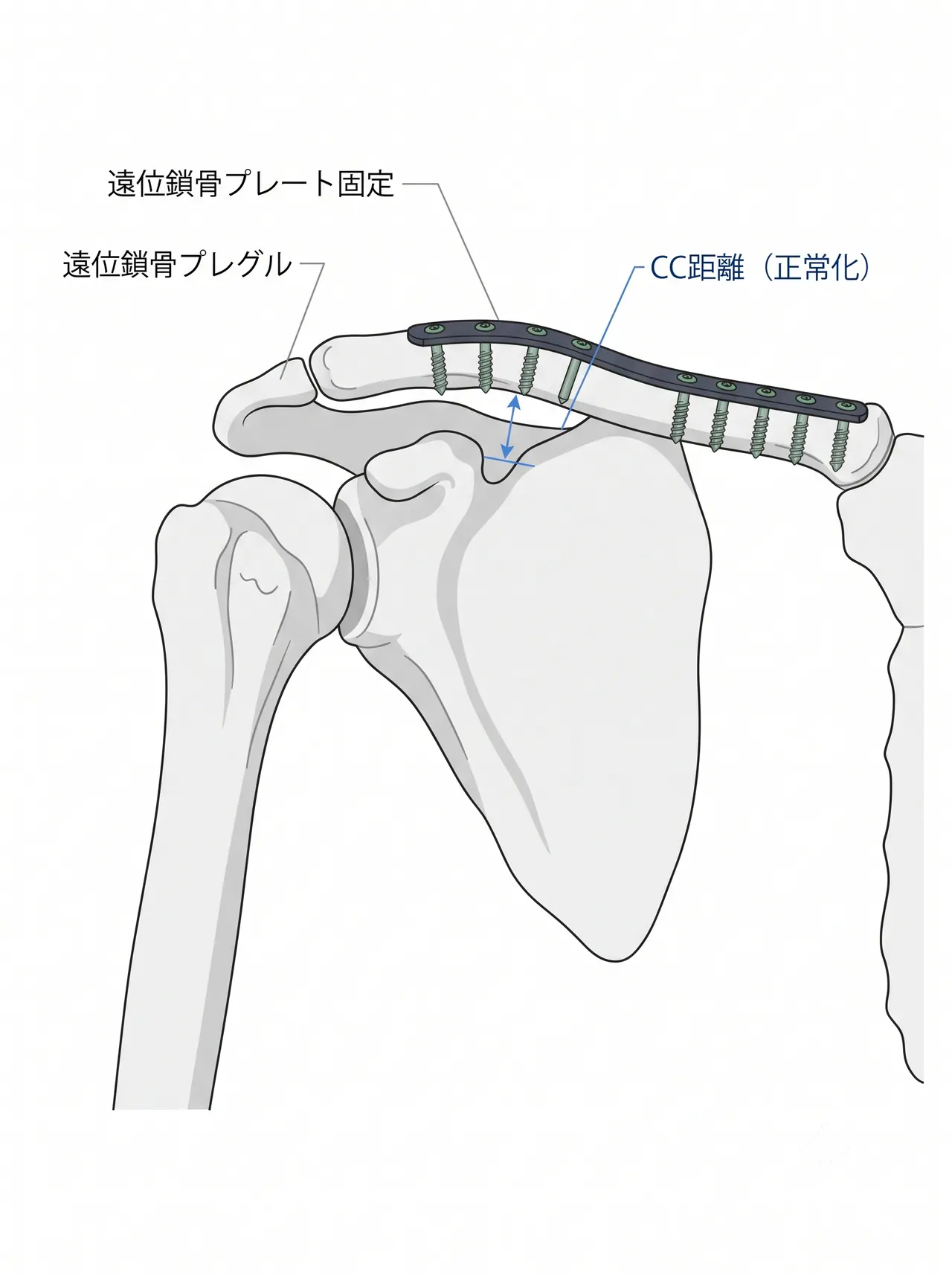 術後X線像（正面）— プレート固定・CC距離正常化の確認