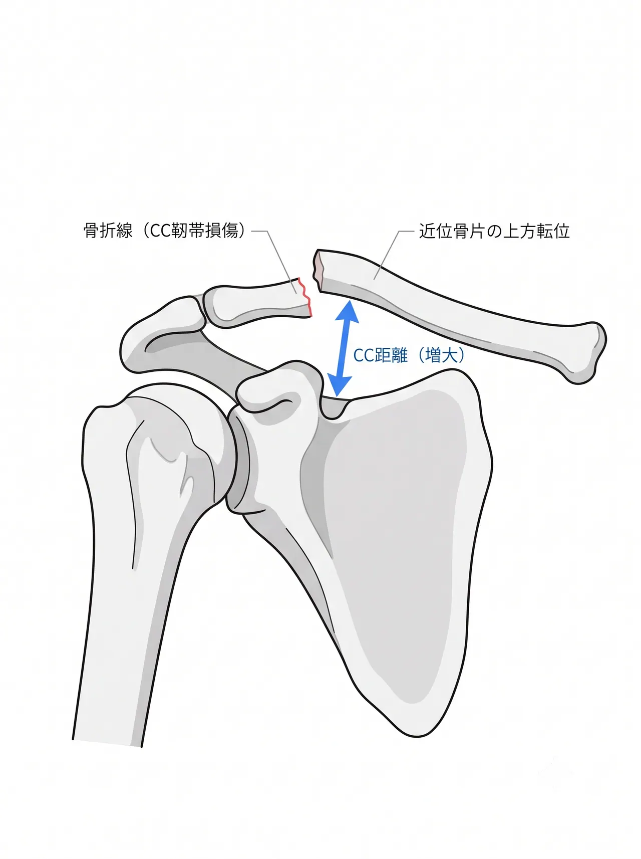 X線正面像 — 近位鎖骨上方転位・CC靭帯損傷型（14-B2）