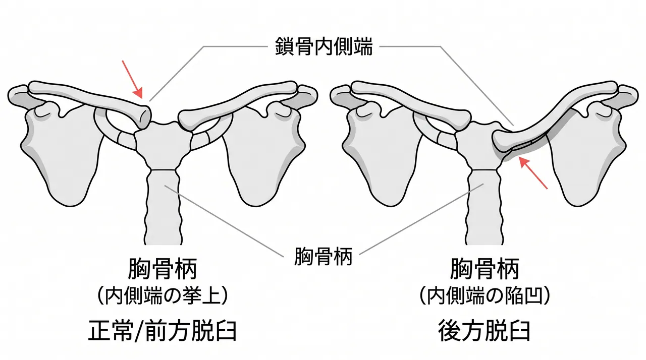 胸鎖関節X線（serendipity view）— 前方・後方の識別