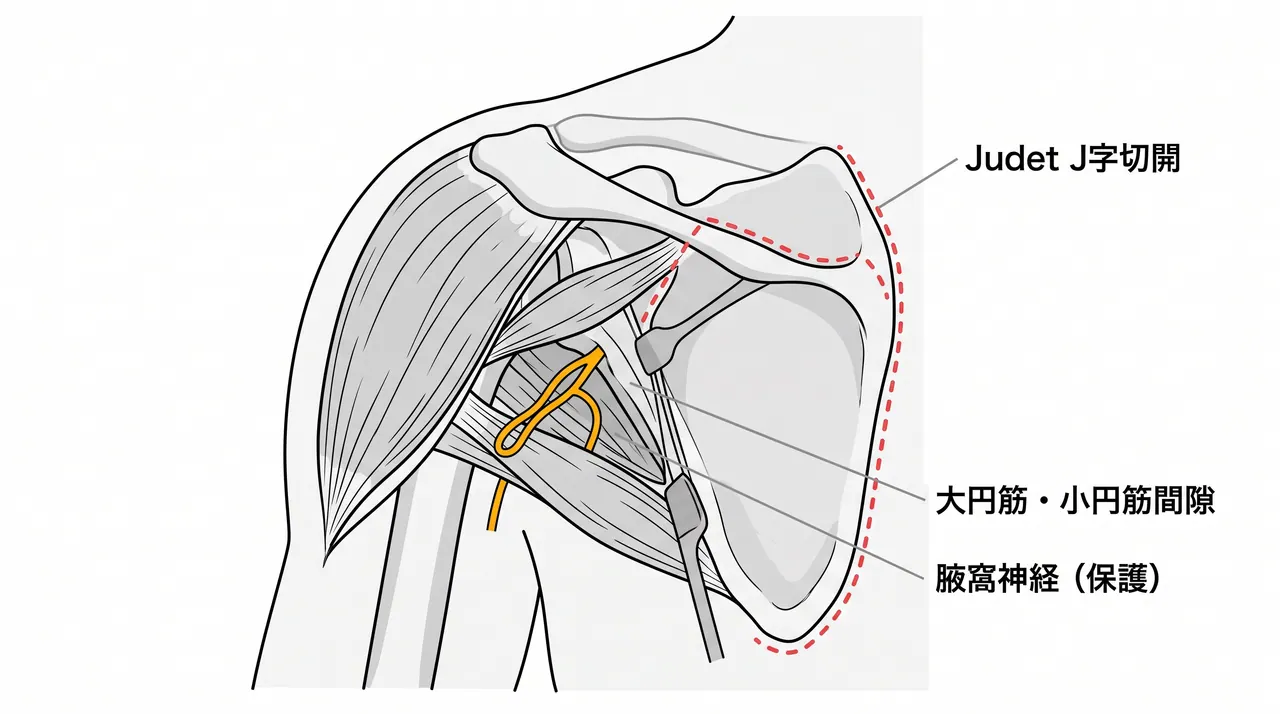 後方アプローチ（Judet）— 大円筋・小円筋間隙の展開