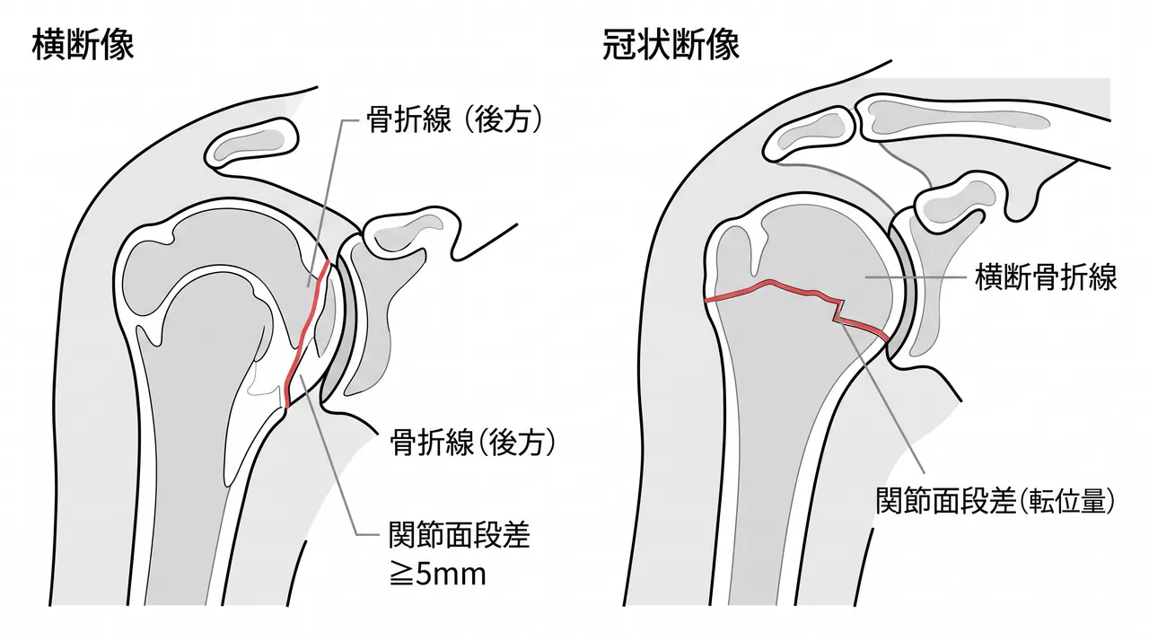 CT横断像・冠状断像 — 骨折線・転位量・骨頭中心化の評価
