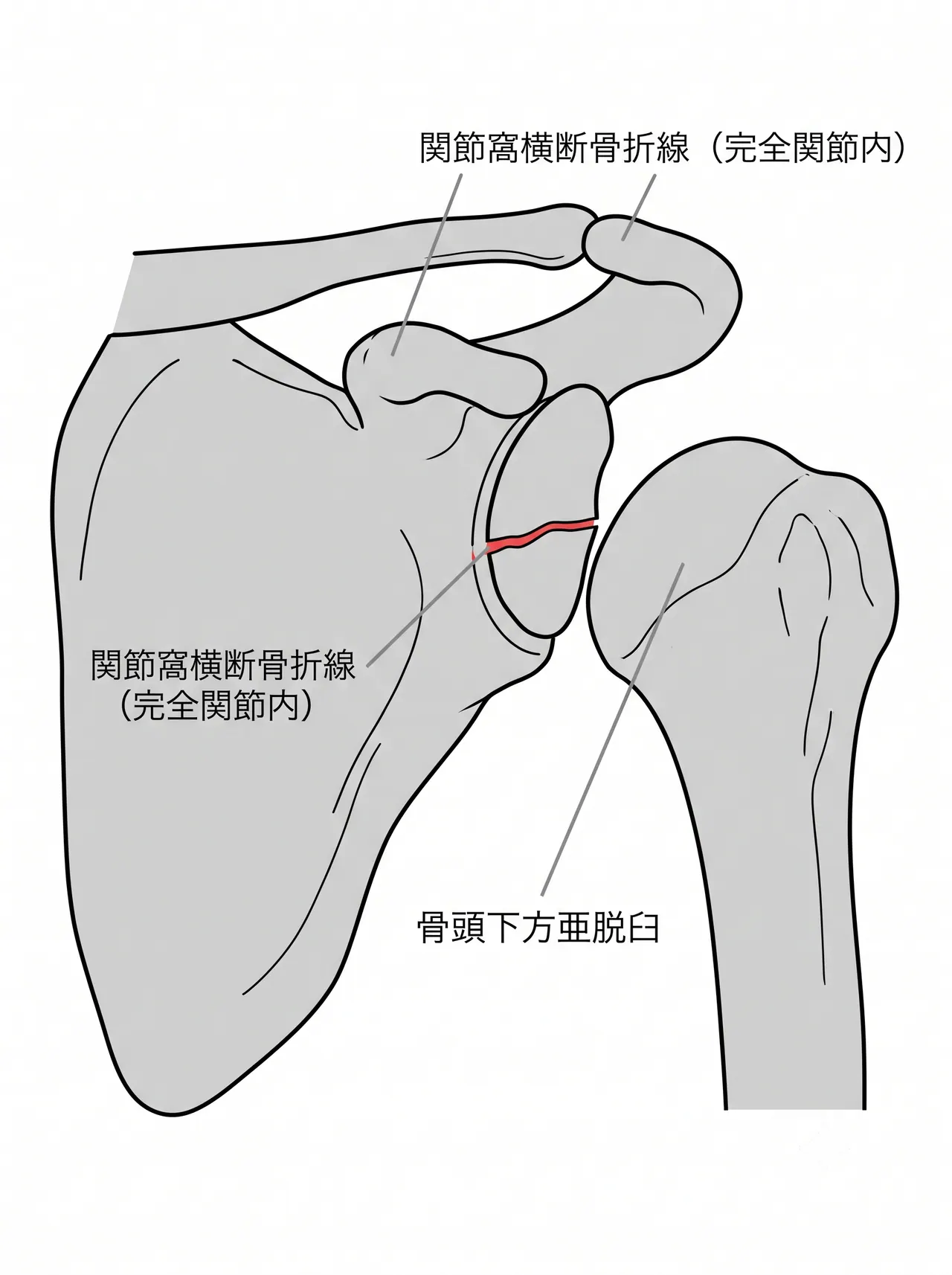 X線正面像 — 関節窩骨折・骨頭位置の評価