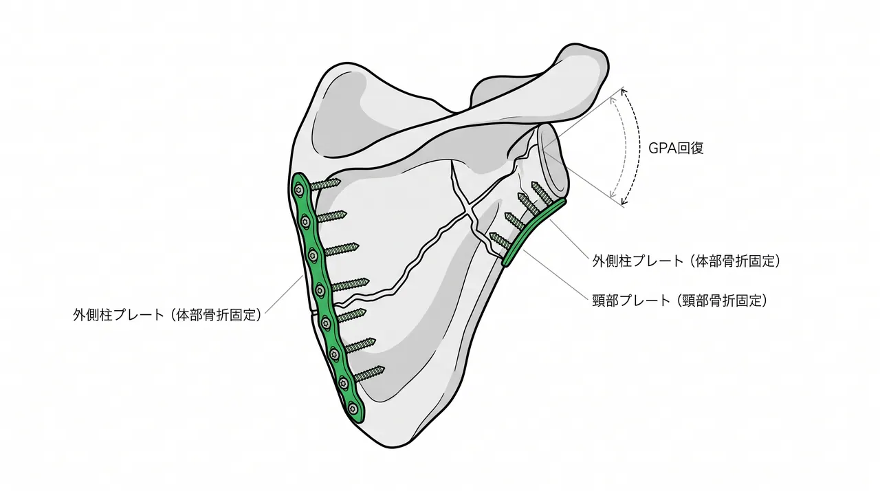 固定構成 — 体部再建プレート＋頸部プレートによる二方向固定（＋floating shoulderでは鎖骨プレート追加）