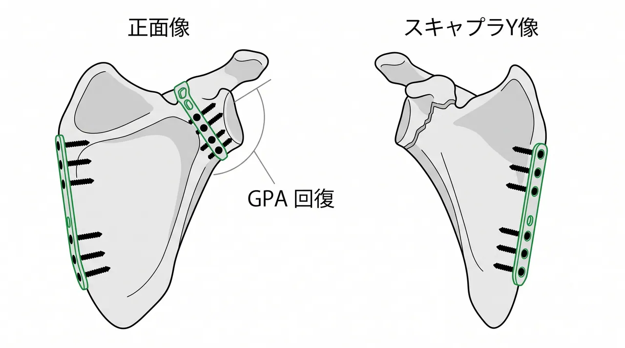術後X線像（正面像・スキャプラY像）— プレート固定後の整復位確認