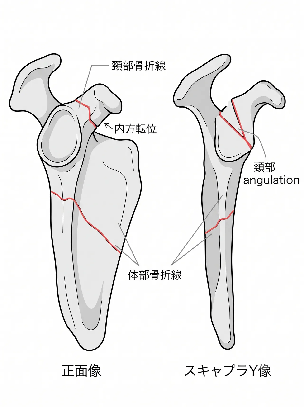 X線評価 — 肩甲骨体部骨折線の頸部延長パターン（AP像・スキャプラY像）