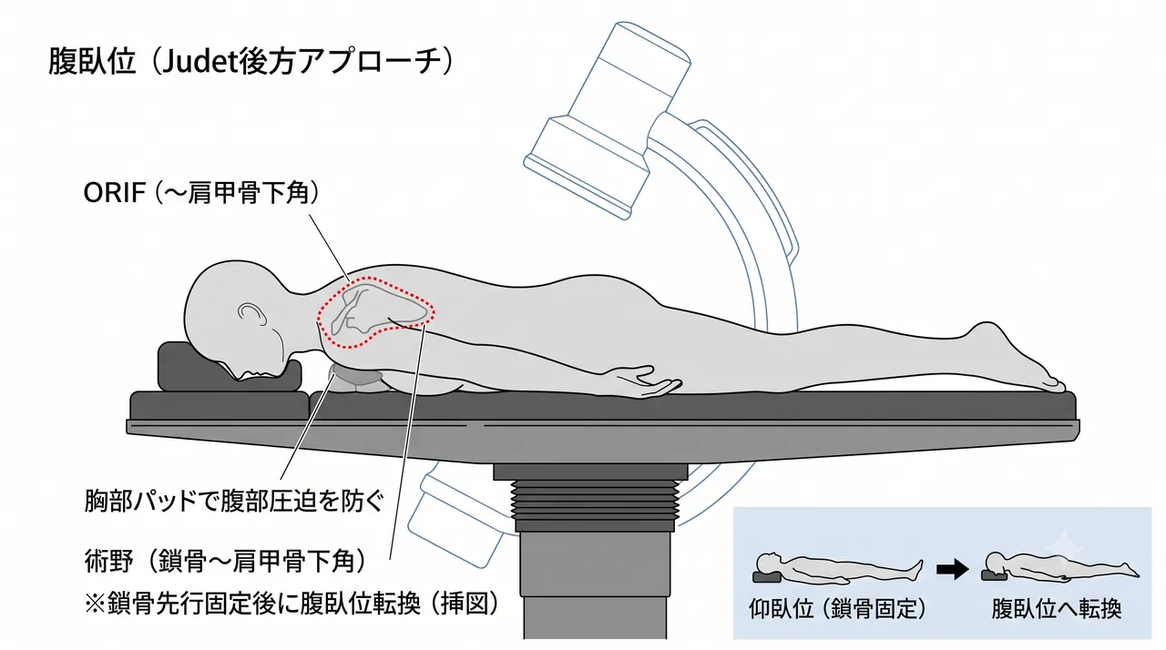 体位 — 腹臥位によるJudet後方アプローチ（鎖骨固定後に腹臥位転換、または最初から腹臥位で鎖骨を前方からアプローチ）