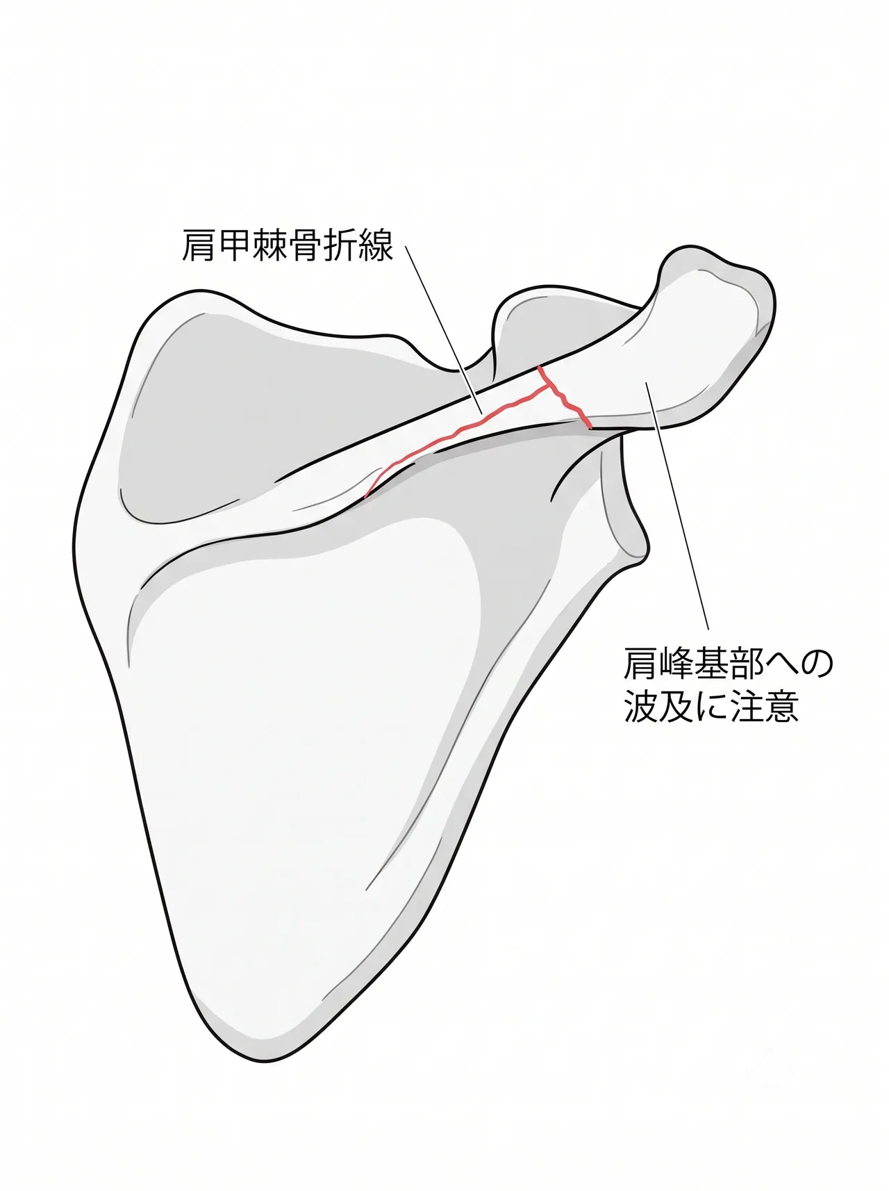 X線 — 肩甲骨正面・スカプラY像による肩甲棘骨折・転位の評価